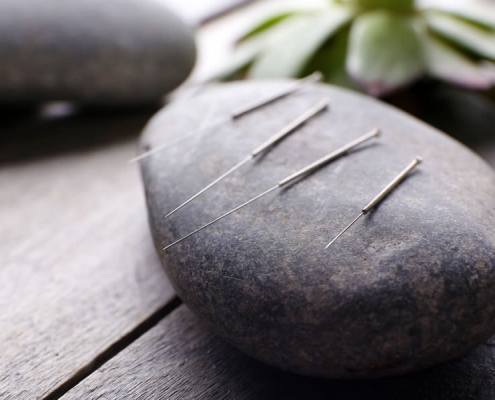 Acupuncture 101 - Questions about Acupuncture