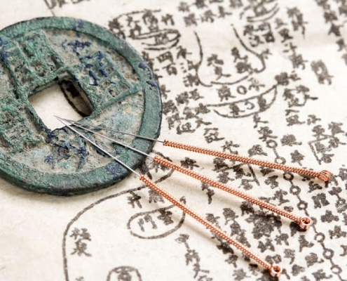 Can Acupuncture Help?